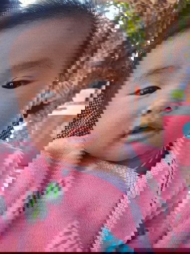 น้องมีชั้นตาไม่เท่ากัน