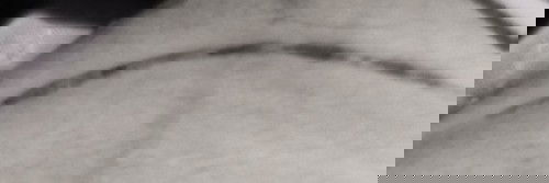 Bekas SC sperti kiloid