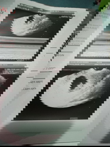 Anxious about TVs Result