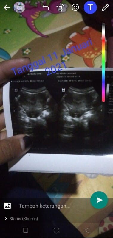 Adakah yg bisa menjelaskan hasil USG saya🙏
