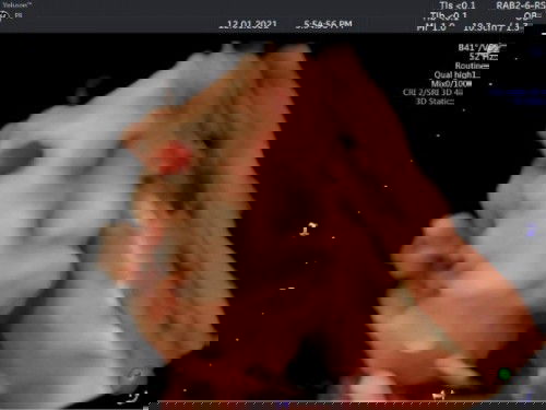 Em mới đi siêu âm về 33w bé 2k1 bs nói là dây rốn quấn cổ. Em hỏi thì bs bảo k sao. Em lo quá các m