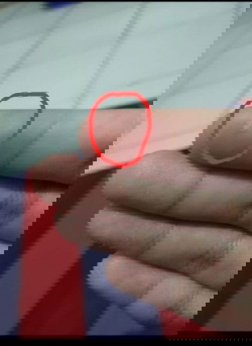 benjolan di telunjuk