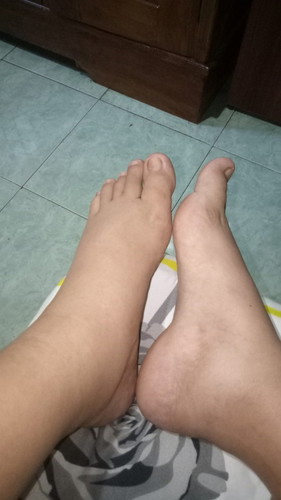 apa penyebab kaki membengkak pada usia kehamilan 8 bulan ?