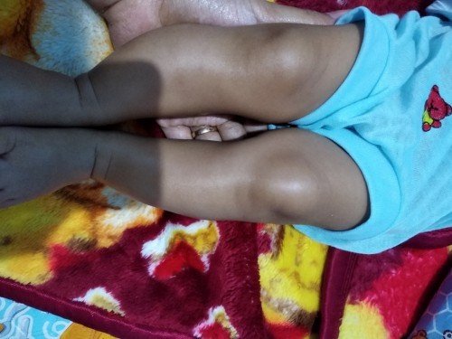 Kaki pada anak