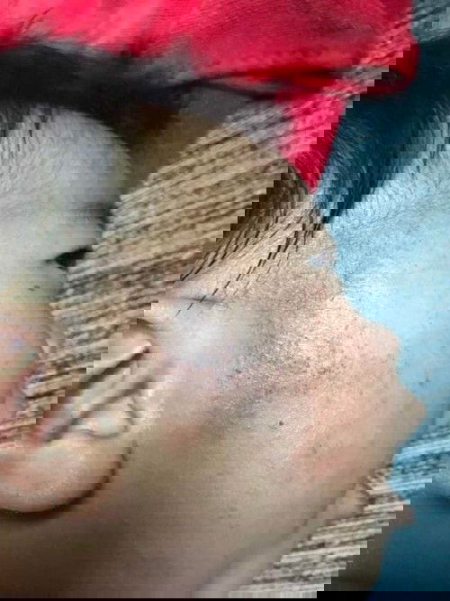 ผิวหน้าลูกแดงแห้ง