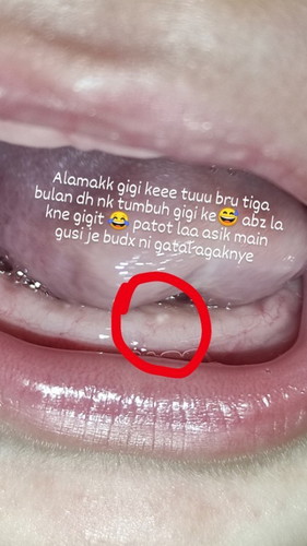 baby 3bulan tumbuh gigi?