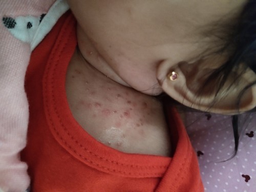 What kind of Rashes?