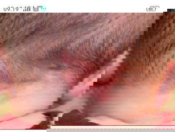 Ruam merah di kepala