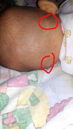 kepala bayi bagian belakang bawah ada benjolan