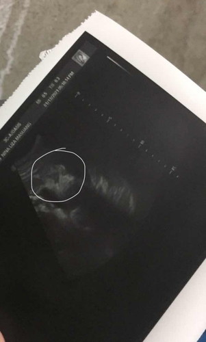 Ultrasound Result