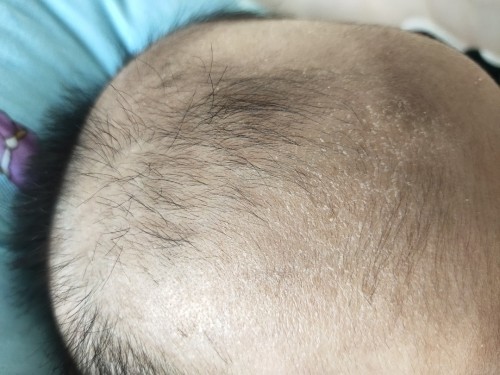 ลูกๆบ้านไหนผิวบนศรีษะเป็นแบบนี้บ้างและแม่ๆมีวิธีแก้ไขกันยังไงค่ะ..ขอบคุณล่วงหน้าค่ะ