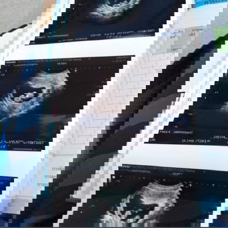 ตั้งครรภ์ลูกแฝด