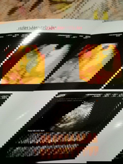 Khoẻ hình ảnh siêu âm