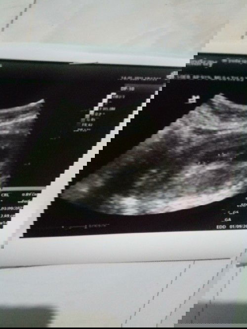 Hpht dan usg tidak sama