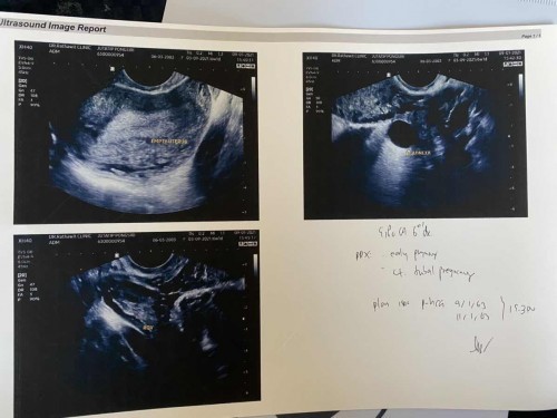 ซาวด์6w1d ไม่เจอถุงน้ำคล้ำ