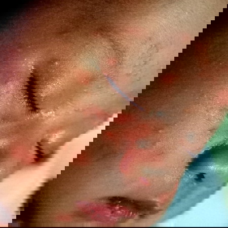 Ano po kaya nangyari sa face ng baby ko 18days old na po si Baby lactacyd po gamit niya any advise?