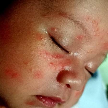 Ano po kaya nangyari sa face ng baby ko 18days old na po si Baby lactacyd po gamit niya any advise?