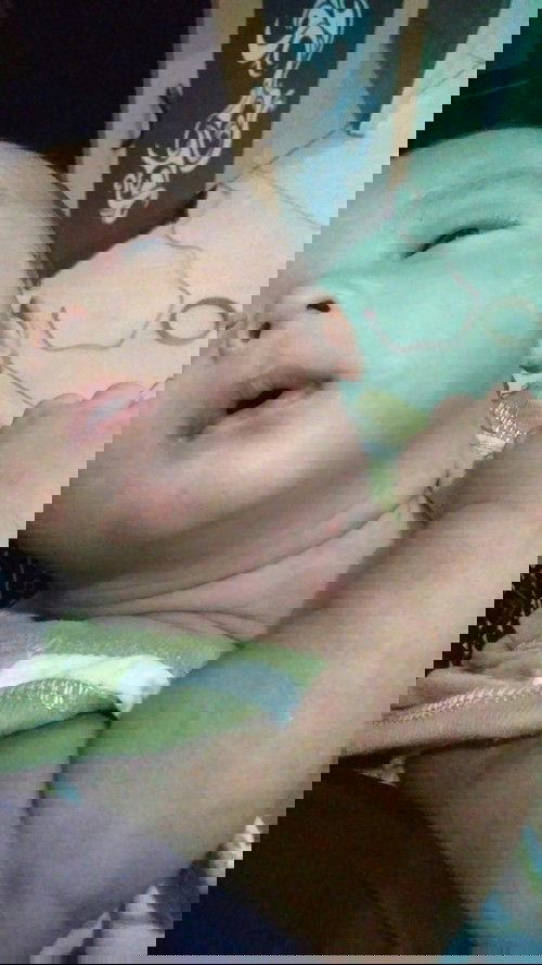 ruam merah pada bayi