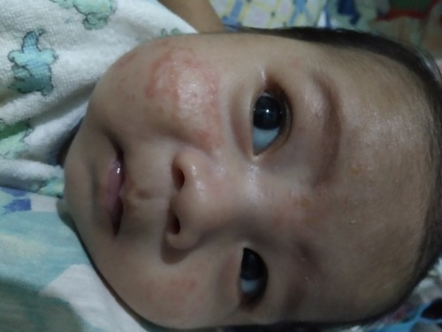 Rashes sa pisngi ni baby dahil sa halik