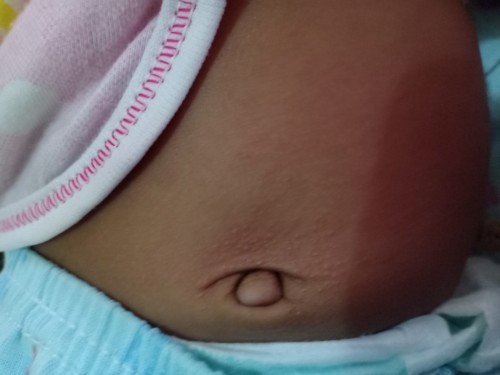 Ini gatal gatal kah?