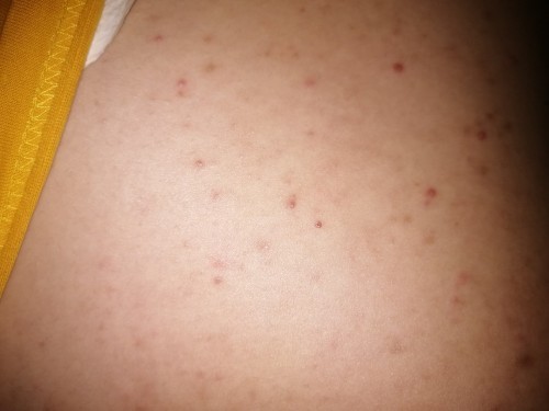 Dami ko ganito sa tiyan ko.. Normal lang po ba ito? Minsan makati pero minsan hindi naman. 28weeks.