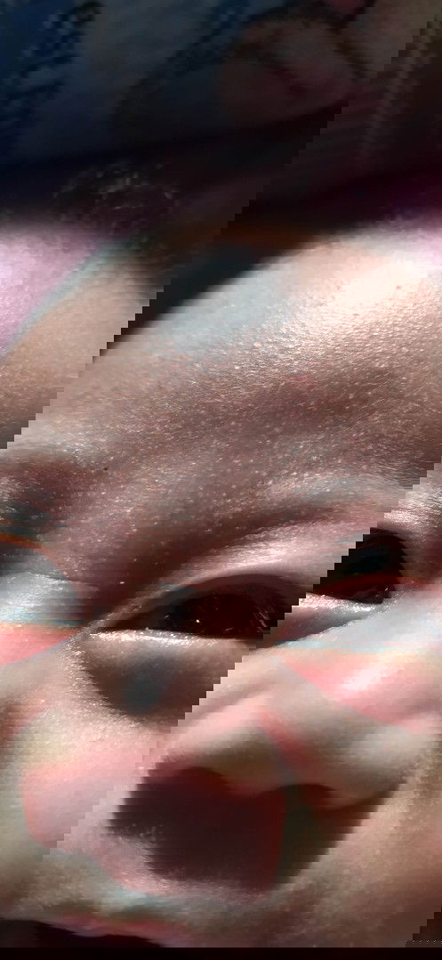 Bruntusan kulit bayi