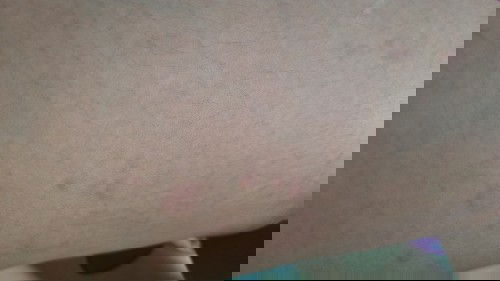 Obat biduran(utrikaria) untuk ibu hamil trimester 1 ?