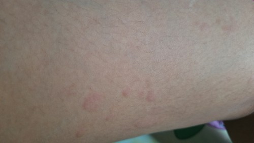 Obat biduran(utrikaria) untuk ibu hamil trimester 1 ?