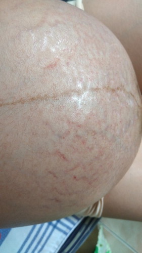 stretchmark