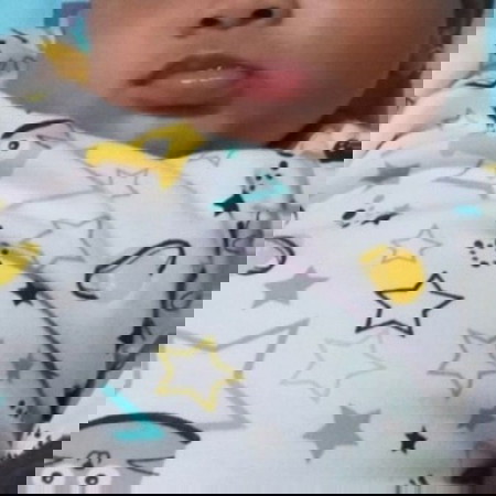 Tentang muka bayi putih seperti panu