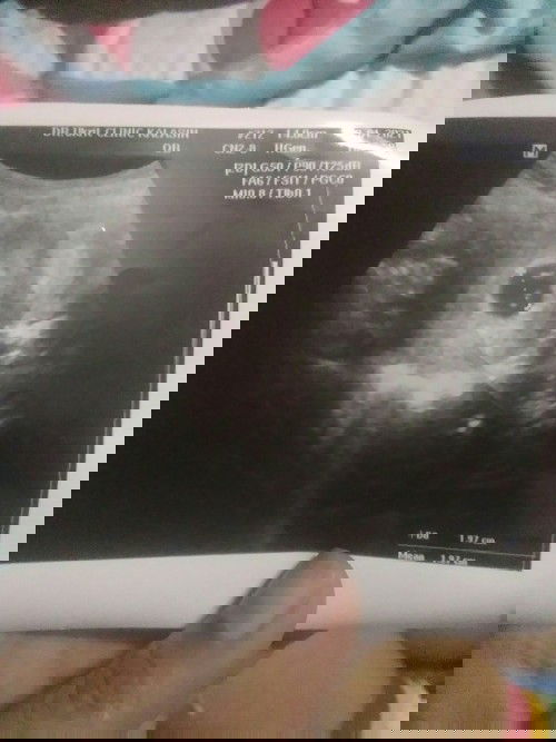 อาการเลือดไหล