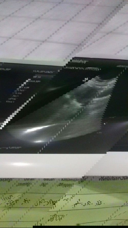 janin blm terlihat tetapi penebalan rahim +