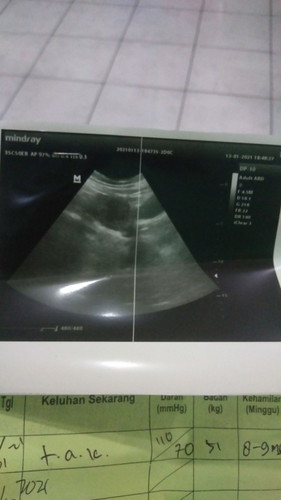 janin blm terlihat tetapi penebalan rahim +