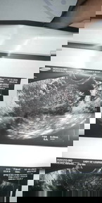 1st ultrasound dec 15,2020