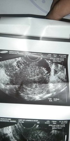 1st ultrasound dec 15,2020