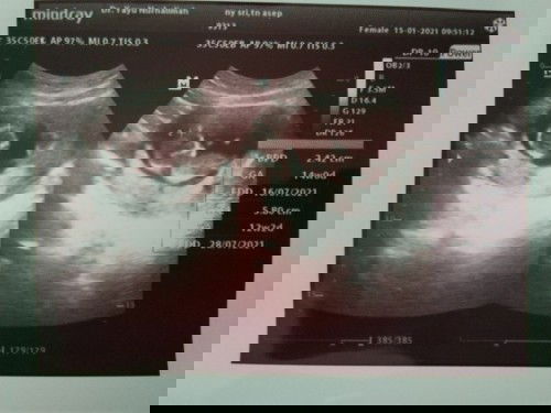 Alhamdulillah USG pertama