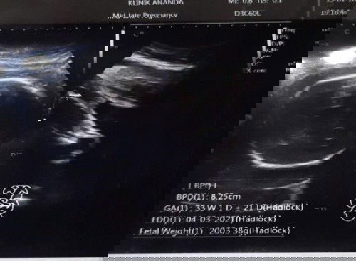 Usia kandungan 7 bulan bb bayi 2 kg.