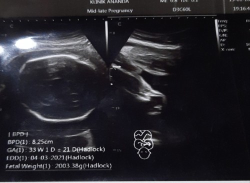 Usia kandungan 7 bulan bb bayi 2 kg.