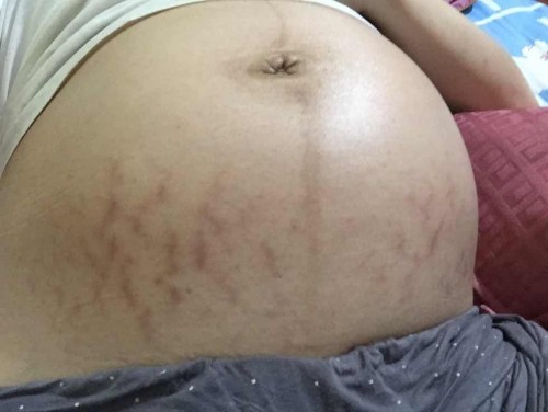 Red or purple stretch marks