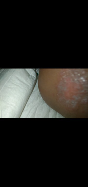 Luka pada pantat bayi