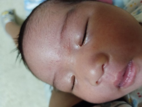 Baby rash or Neonatal Acne.... Help po...