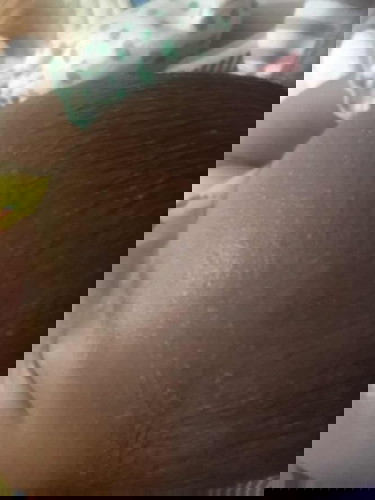 Bintik di wajah dan leher bayi