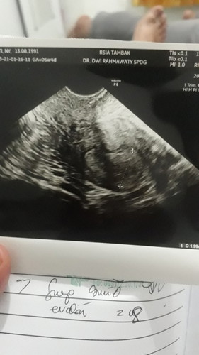 Janin Belum Terlihat