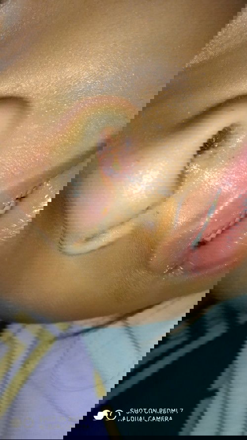 Jerawat apa gimana ya