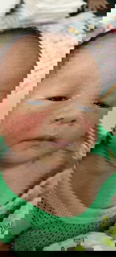 เป็นผืนเต็มหน้าเริ่มลามไปที่คอ