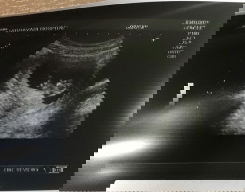 มีแม่ท้องที่ทำ  IUI ไม่ติด แต่ติดเองธรรมชาติเหมือนเราไหมคะ