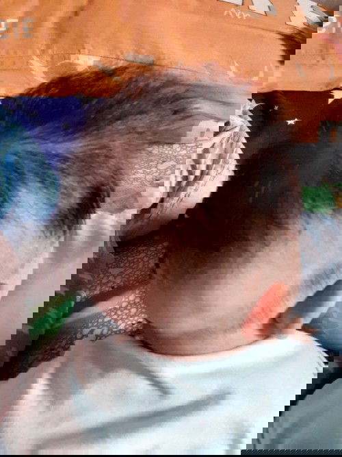 ผมลูกเราผ้าอ้อมกัดเป็นแบบนี้ทำไงถึงจะหาย😒มีลูกแม่คนไหนเป็นว่างค่ะ