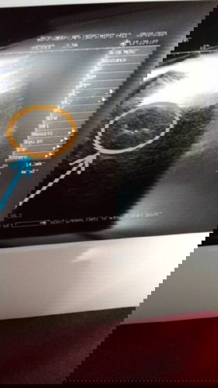 Upt -ve , scan 4 minggu 5 hari