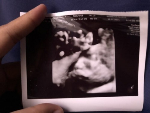 Scan baby tapi babynya malu.