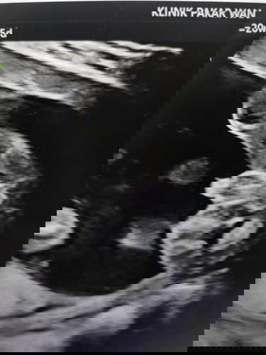 Gender scan